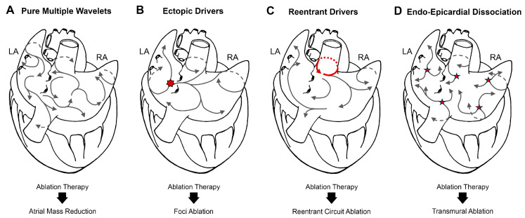 Hybrid Ablation in Atrial Fibrillation: Bridging Mechanistic Understanding and Clinical Practice.
