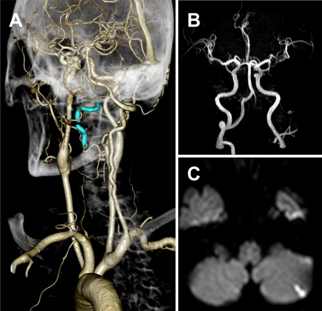 Distal and proximal embolization for penetrating vertebral artery injury: illustrative case.