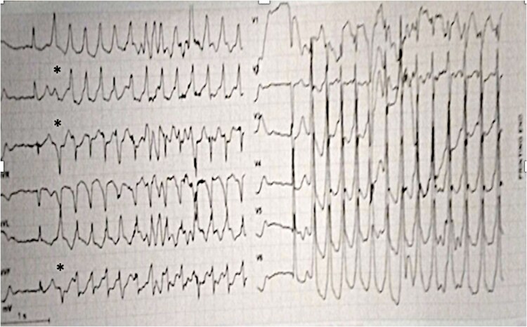 Ablation of ventricular tachycardia originating from the lower and septal portion of aortic prosthesis following transcatheter aortic valve replacement: a case report.