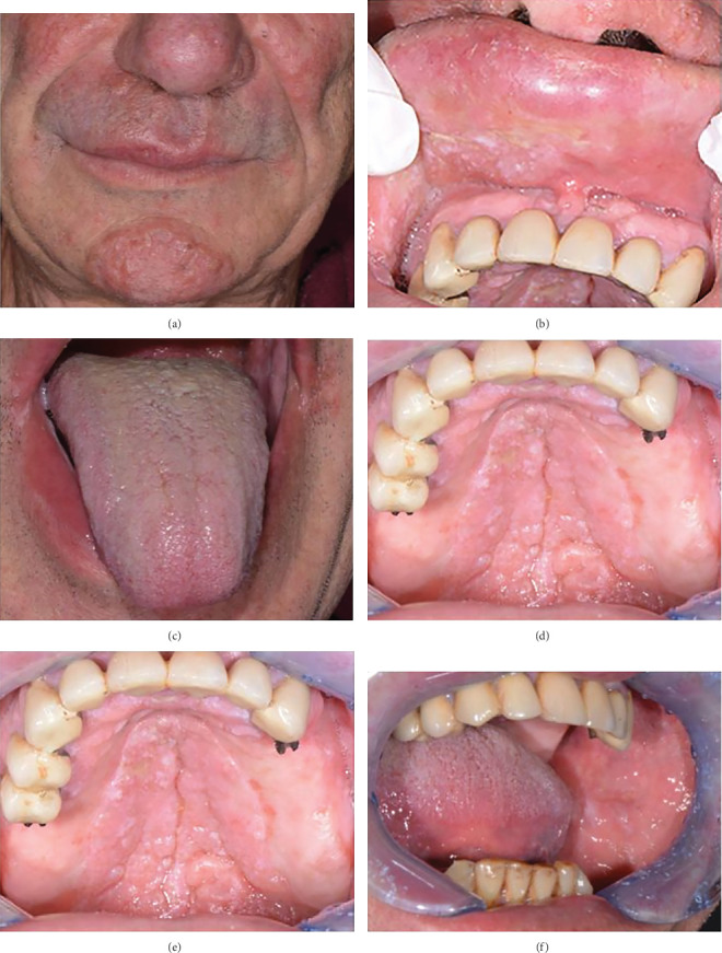 Mucocutaneous Leishmaniasis With Oral Involvement: A Case Report.