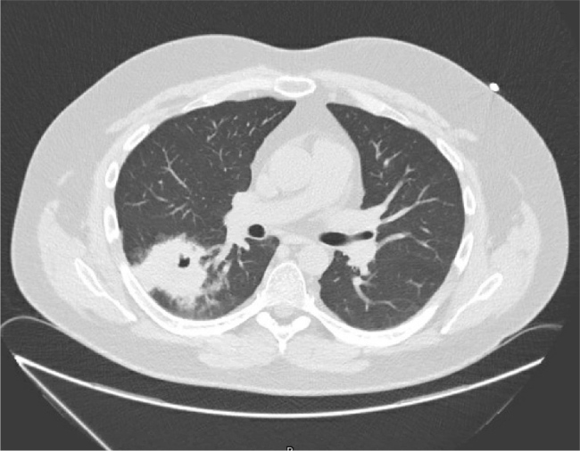 A Silent Invader: Asymptomatic Rhodococcus Infection Unmasked in A Patient with Ectopic ACTH-Dependent Cushing's Syndrome.