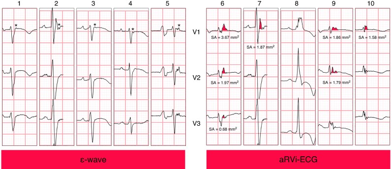 Different underlying aetiologies in patients presenting with ventricular tachycardia fulfilling task force criteria for arrhythmogenic right ventricular cardiomyopathy: initial suspicion based on the 12-lead electrocardiogram.