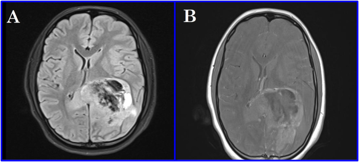 Symptomatic postoperative cyst following glioma excision in a pediatric patient: a case report.