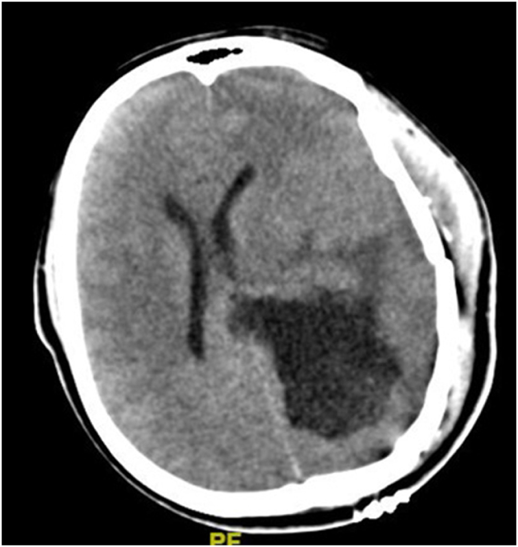 Symptomatic postoperative cyst following glioma excision in a pediatric patient: a case report.