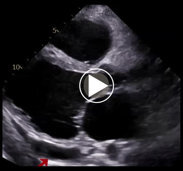 Crucial Role of Early Detection in Managing Heart Failure in Kearns-Sayre Syndrome: A Case Report.