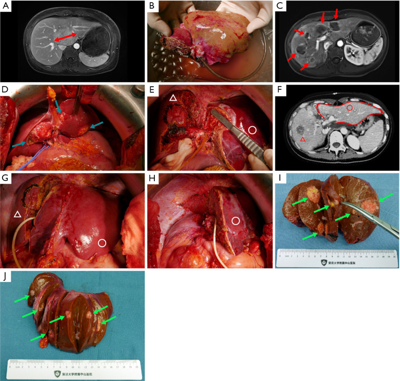 Auxiliary liver transplantation using otherwise-discarded liver allograft combined with associating liver partition and portal vein ligation for staged hepatectomy for unresectable colorectal liver metastases.