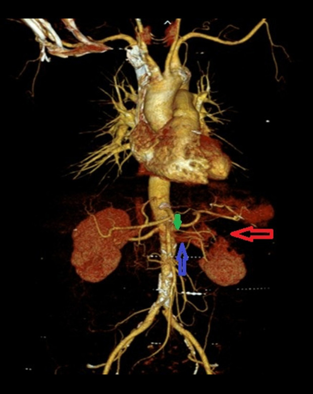 Transient Renal Artery Stenosis in Renal Infarction: A Case Report.