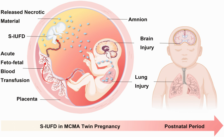 Beneath a silent attack: Unraveling lung and brain injuries in a surviving monoamniotic twin.