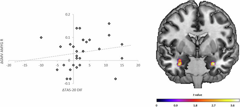 Limbic gray matter increases in response to cognitive-behavioral therapy in major depressive disorder.