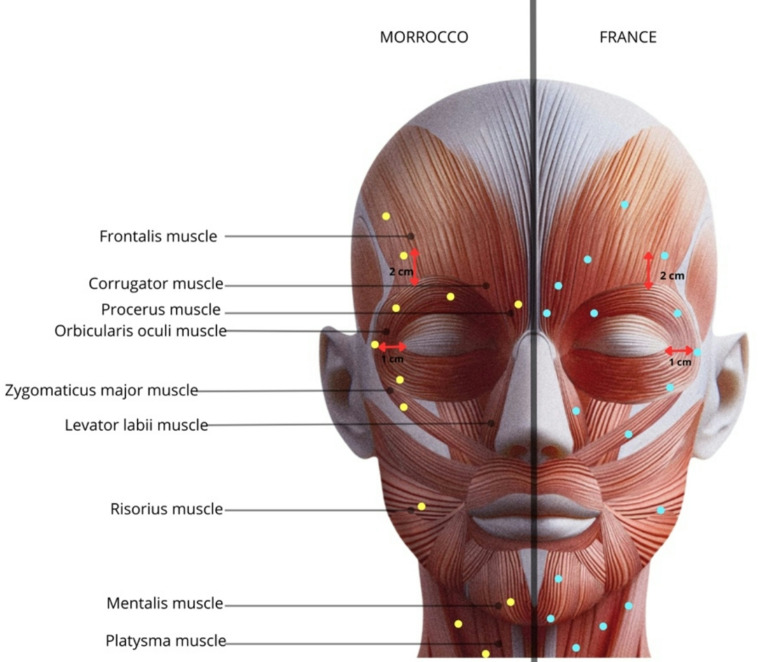 Multicentric comparative study of botulinum toxin treatment in patients with hemifacial spasm.