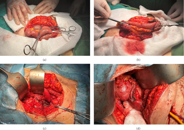 Metachronous Bilateral Nephrectomy, Supratrigonal Cystectomy, and Living Donor Renal Transplantation in a Patient With Chronic Kidney Disease due to Interstitial Cystitis and Total Urethral Stricture.