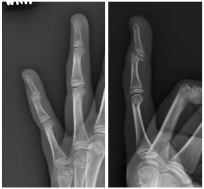 Open Reduction and Internal Fixation of a Volar Displaced Salter-Harris III Mallet Fracture in a Pediatric Patient: A Case Report.
