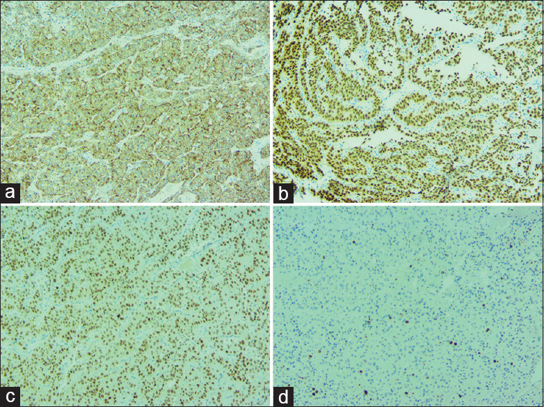 Metastasis of follicular carcinoma of the thyroid gland to the mandible: A report of a rare case.
