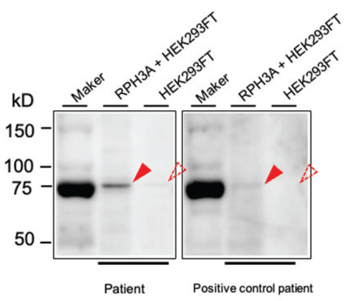 Diagnosis of Lymphocytic Infundibuloneurohypophysitis After Positive Anti-rabphilin-3A Antibody Test in an 8-year-old Boy with Early-onset Central Diabetes Insipidus