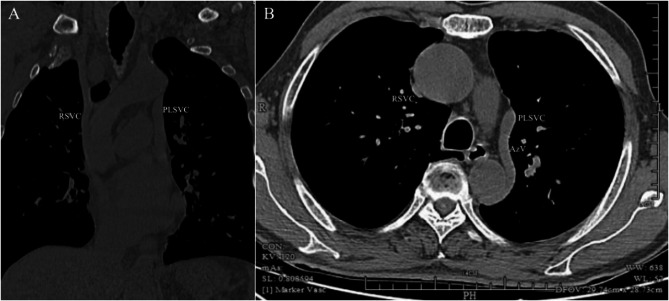 Venous Port implantation in persistent left superior vena cava with azygos vein variation: a case report and literature review.