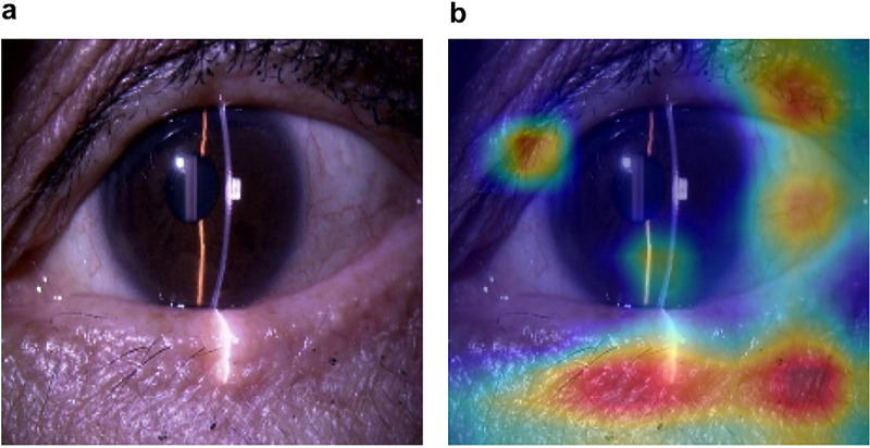 A Deep Learning Model for Detecting the Eyes Receiving Glaucoma Medications Using Anterior Segment Images.