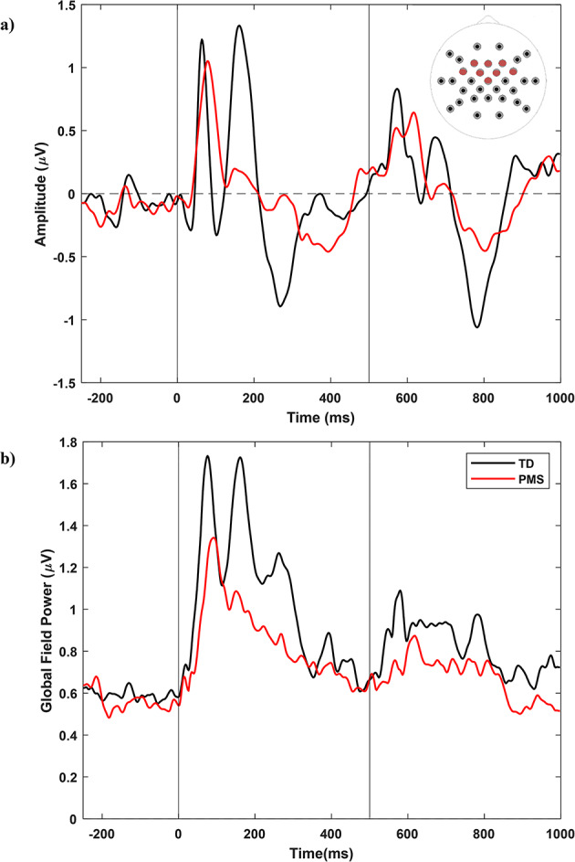Phenotypic variation in neural sensory processing by deletion size, age, and sex in Phelan-McDermid syndrome.