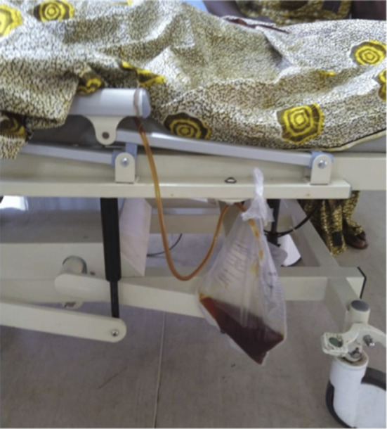 Henna-Induced Intravascular Hemolysis in a Glucose-6-Phosphate Dehydrogenase-Deficient Ghanaian Female Child with Full Defect.