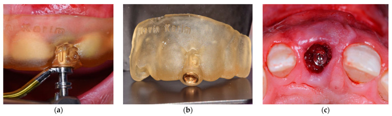 Comparative Evaluation of Customized CAD/CAM vs. Stock Titanium Abutments for Immediate Implant Placement in Class II Extraction Sockets: A Randomized Controlled Trial.