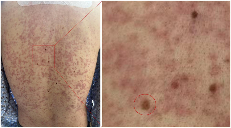 Viral-Induced Erythema Multiforme Complicated by Secondary Bacterial Infection with Hyperpyrexia Following Cervical Spine Surgery: A Rare Case of Dual Infection.