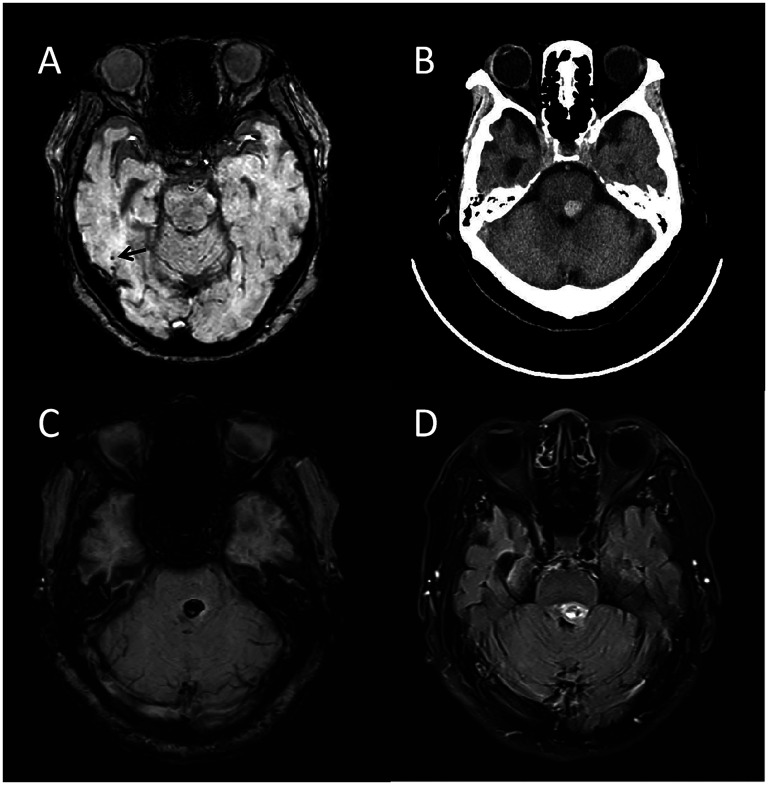 Probable lecanemab-associated pontine hemorrhage following cardiovascular intervention: Clinical implications for lecanemab use.