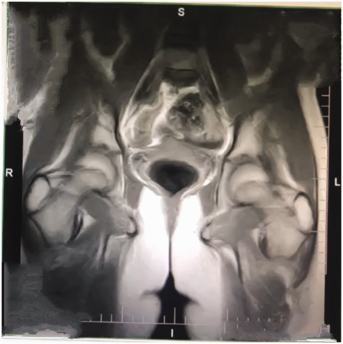Swyer syndrome in a Syrian female: A rare case report.