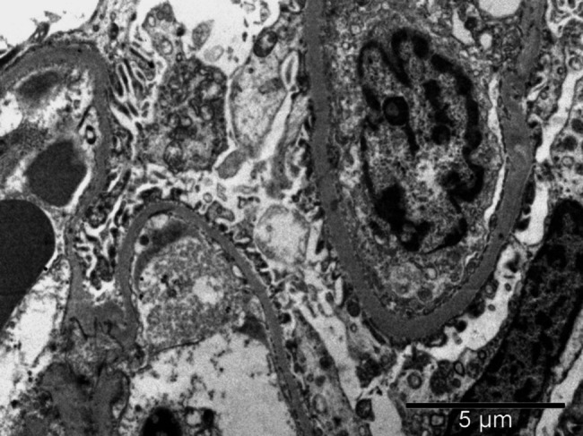 How does LAMB2 contribute to kidney disease? Insights from a pediatric case.