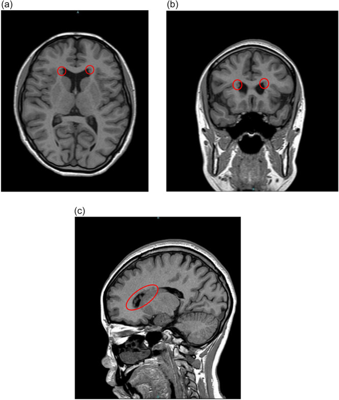 Successful use of clozapine in a patient with schizophrenia comorbid with 22q11.2 deletion syndrome and multiple periventricular nodular heterotopia: A case report.