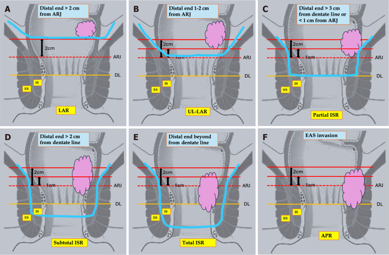 Predictive model for sphincter preservation in lower rectal cancer.