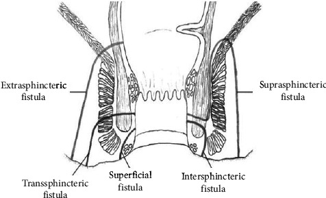 Gastrointestinal Fistulas-What Gastroenterologists Need to Know in 2025.