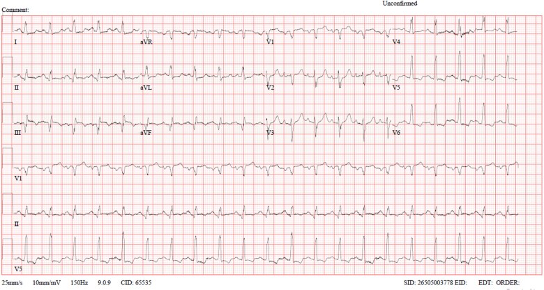 Severe cardiopulmonary complications of ketamine: Acute pulmonary Edema in a cardiac patient.
