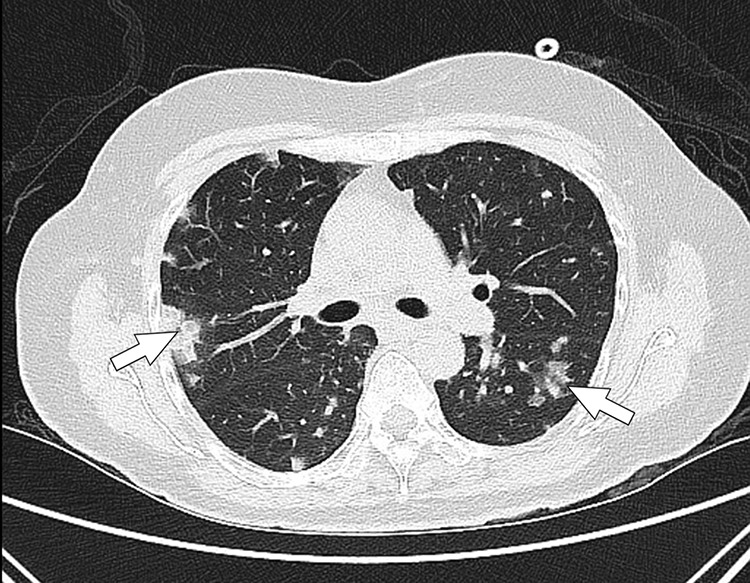 Inferior Vena Cava Septic Thrombophlebitis: A Severe Complication of Paraspinal Steroid Injection Leading to Methicillin-Resistant <i>Staphylococcus aureus</i> Dissemination.