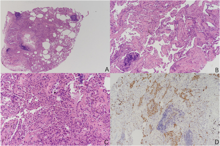 The Dual Threat Combined Pulmonary Fibrosis and Emphysema (CPFE): Two Cases.
