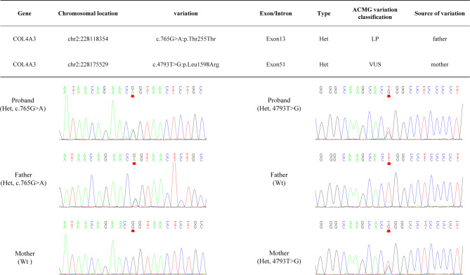 Pathogenic synonymous variation of the COL4A3 gene causing Alport syndrome comorbid with IgA deposition in a toddler: a case report.