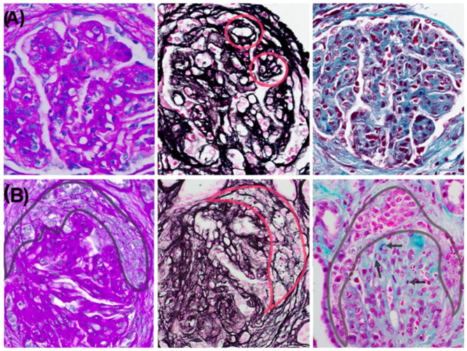 An Unusual Case of Membranoproliferative Glomerulonephritis: Is the Role of Vaccination in Immune Reactivation a Casual or Causal Effect?