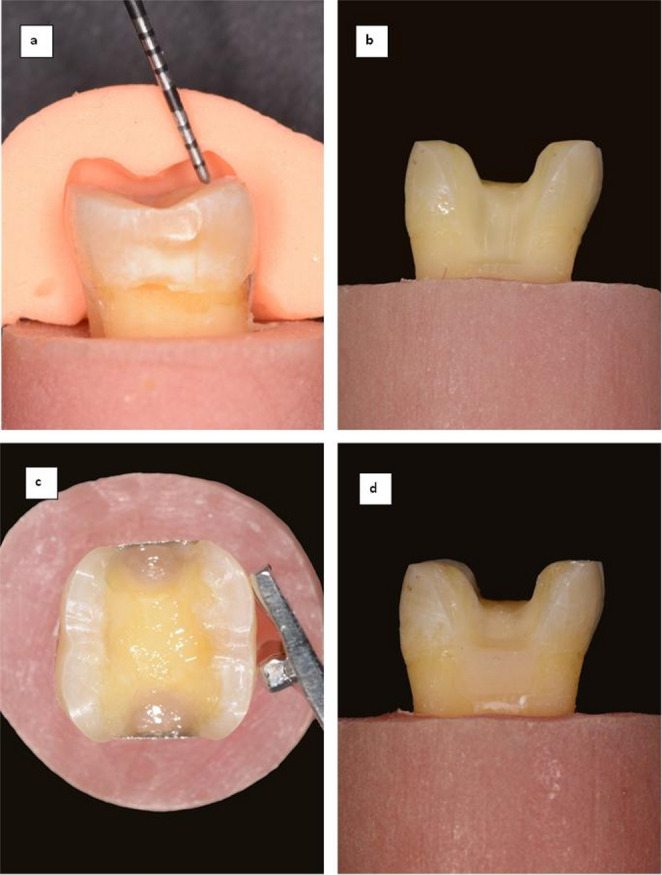 Fracture resistance of molars receiving nanoceramic-resin CAD/CAM onlays after cervical marginal elevation with different injectable restorative materials: effect of six-month water storage.