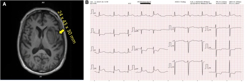 Concurrent inferior stemi with third-degree AV block and acute intracranial haemorrhage: how we overcame this clinical challenge-a case report.