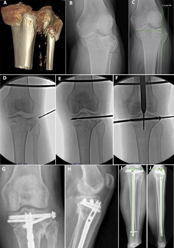 Residual radiographic fracture displacement in healed tibial plateau fractures: comparison after treatment with suprapatellar nailing versus lateral plating.