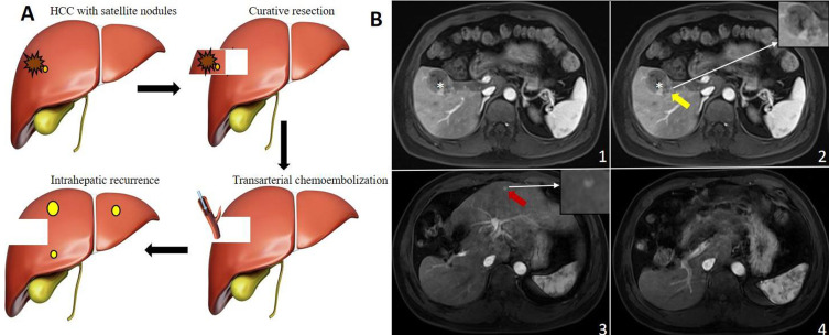 A Clinical-Imaging Nomogram for Predicting Early Recurrence in Patients with Solitary Hepatocellular Carcinoma After Postoperative Adjuvant TACE.
