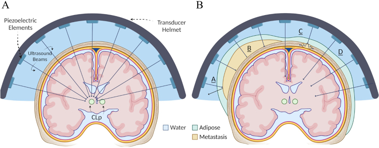 MRI-guided focused ultrasound thalamotomy for neuropathic pain in an adolescent with cranial metastases: illustrative case.