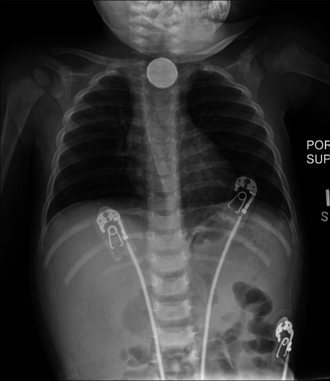 Management of a Pseudoaneurysm After Carotid-Esophageal Fistula Repair Secondary to Button Battery Ingestion in an Infant.