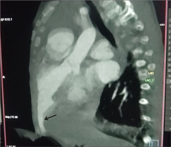 Mind the right ventricle: Tackling right heart dysfunction in left ventricular diverticulum with omphalocele.