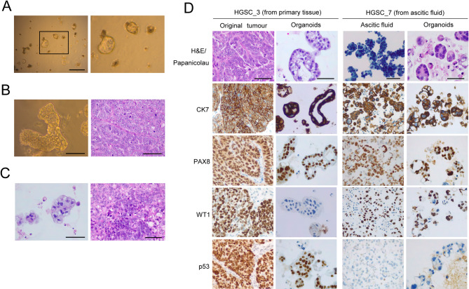 Patient-derived organoids as a model to study tubo-ovarian carcinoma: a pathologist's perspective.