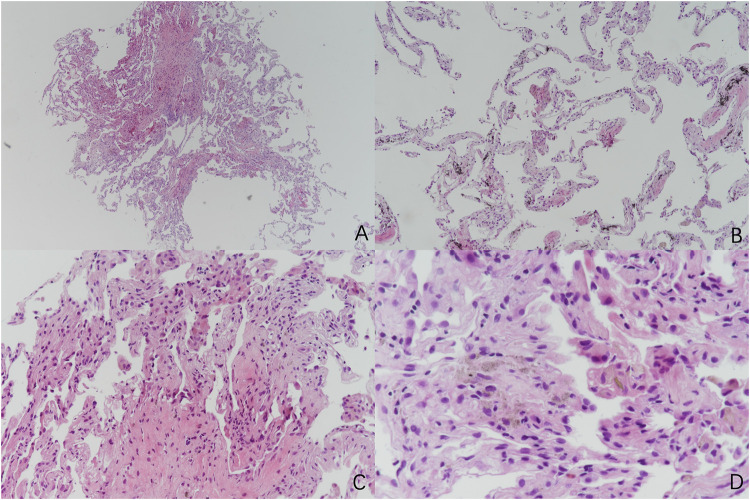 The Dual Threat Combined Pulmonary Fibrosis and Emphysema (CPFE): Two Cases.