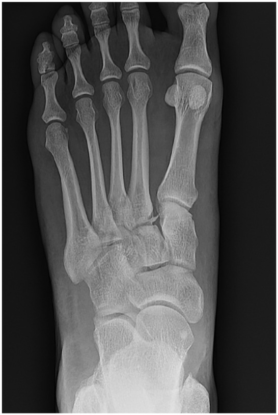 Clinical Outcomes after ORIF vs Arthrodesis for Subtle Lisfranc Injuries: A Minimum 2-Year Comparative Study.