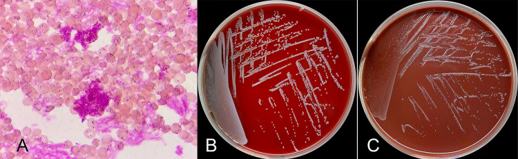 Intrauterine fetal death due to Brucella melitensis infection: a case report and literature review.