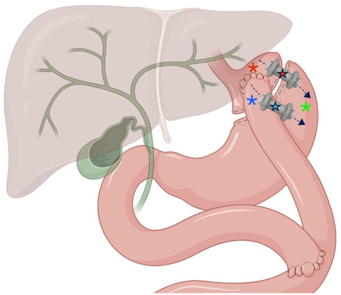 Current status and further directions of endoscopic ultrasound-directed transgastric ERCP and endoscopic ultrasound-directed transenteric ERCP in the management of pancreaticobiliary diseases in surgically altered anatomy: a comprehensive review.