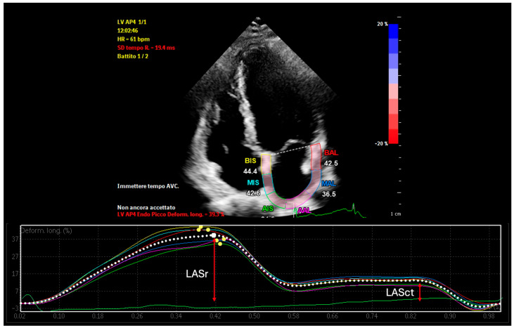 Left Atrial Mechanics and Remodeling in Paroxysmal Atrial Fibrillation: Introducing the EASE Score for Pre-Ablation Risk Prediction.