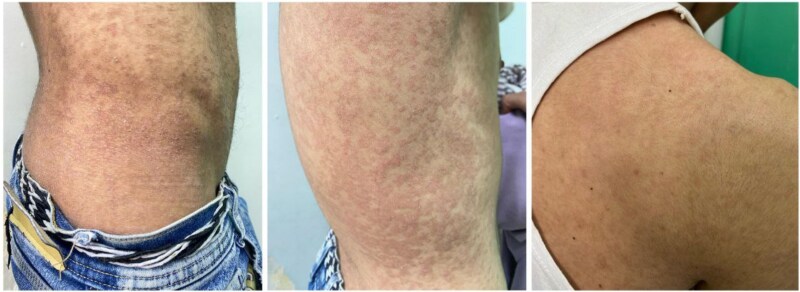 Challenges in diagnosing confluent and reticulated papillomatosis: a case of atypical lesions distribution.