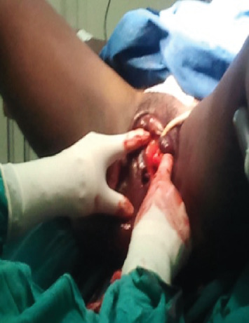 Labium Majus Ectopic Pregnancy: Diagnostic and Therapeutic Implications of a Rare Obstetric Phenomenon-A Case Report.